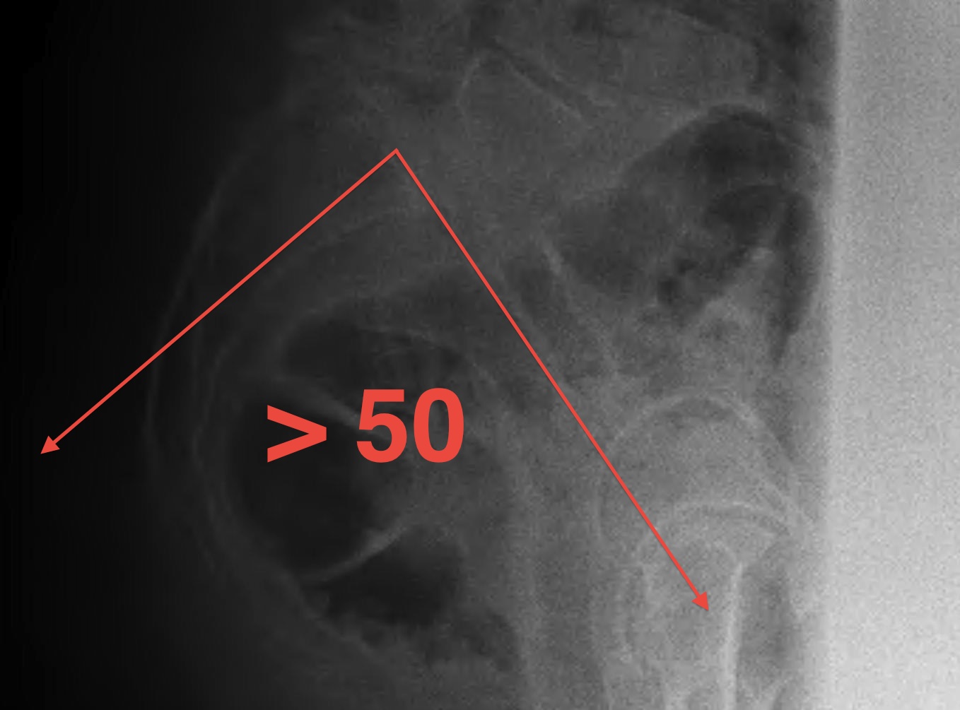 Pelvic Incidence > 50 degrees